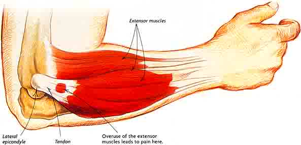 matt-bonner-iphone-injury-2